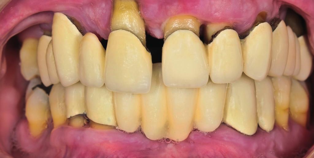Parodontit Parodontit (tandlossning) är ett sjukdomstillstånd som orsakats av långt gången obehandlad tandköttsinflammation.