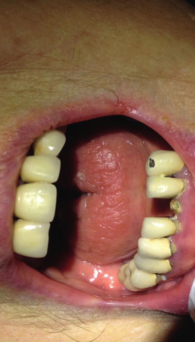 Muntorrhet Muntorrhet innebär att man har för lite saliv i munnen. Detta kan leda till att man ha svårt att svälja och prata samt sveda i tungan. Om man bär proteser kan det skava mer än vanligt.