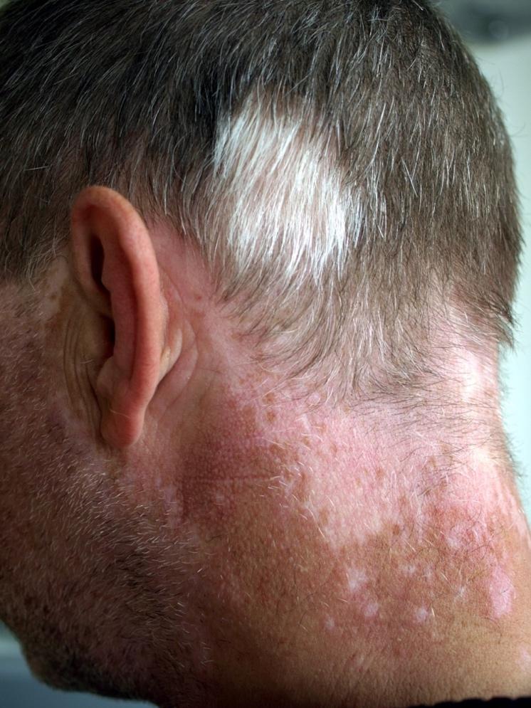 Figur 2. Vitiligo med depigmenterad hud samt påverkan på hår (Wikipedia, Public Domain). Patienter med vitiligo upplever stor psykisk påfrestning samt påverkan på livskvaliteten.