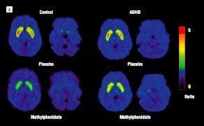 Mindre DA D 2/3 tillgång och nedsatt DA frisättning i striatum