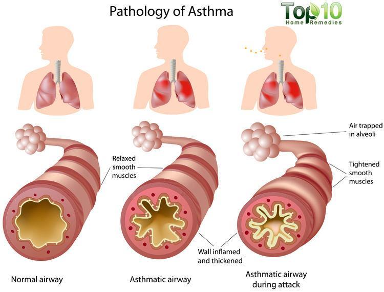 Astma Kronisk inflammation i nedre luftvägar Chronic inflammatory airway disease, increased Ökad