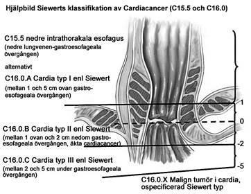 8.5 Gastroskopi Med gastroskopi menas i detta vårdprogram endoskopisk undersökning av esofagus, ventrikel och duodenum.