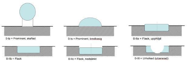 Vävnadsprover ska alltid tas vid misstanke om cancer i samband med gastroskopi. För att uppnå en histologisk sensitivitet > 98 % rekommenderar en äldre studie minst 7 biopsier [34].