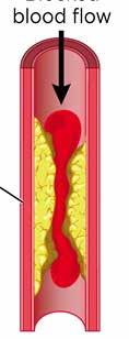 Trombocythämmande läkemedel 5-10% av befolkningen Acetylsalicylsyra (svag) Trombyl Acetylsalicylsyra Klopidogrel (starkare) Clopidogrel Grepid Plavix Tikagrelor (starkast) Brilique Prasugrel