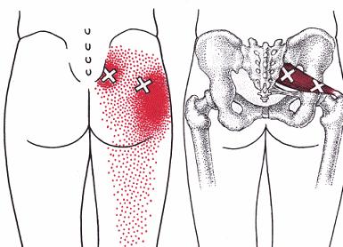 (6) Fokus på Quadratus lumborum (4) Palpera