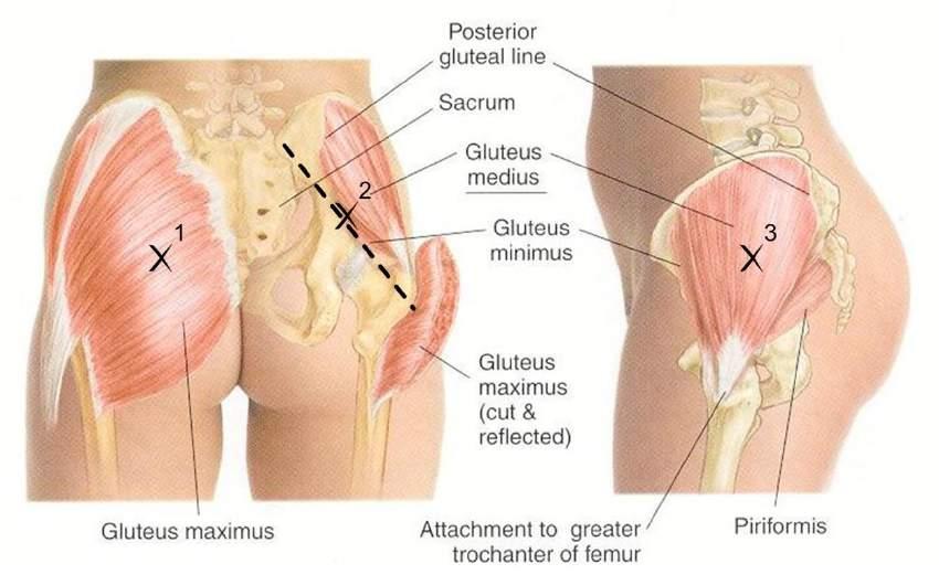 muskelkedjor (1), Gluteus maximus (3) till