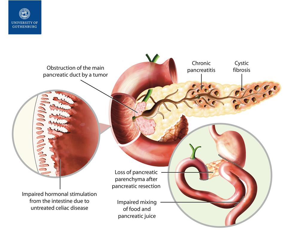 Orsaker till exokrin insufficiens Lindkvist B, World J Gastroenterol.
