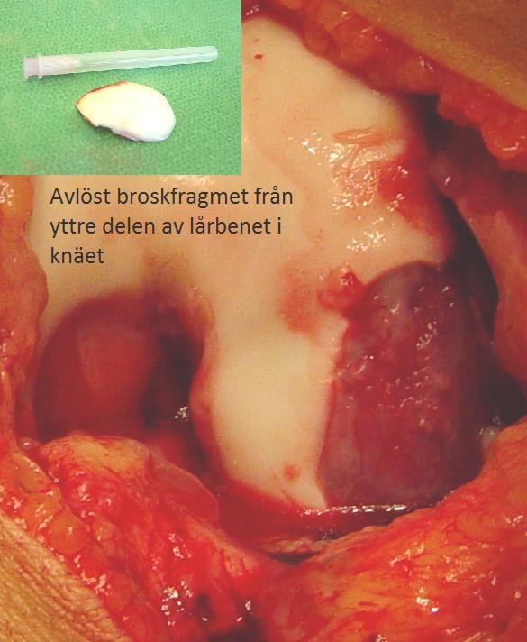 B. Tar bort avlöst broskfragment och mikrofrakturerar skadan.