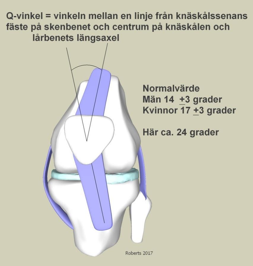 - kobenthet - ökad q-vinkel (förhållandet mellan knäskålssenans fäste på underbenet, knäskålen och lårbenet). Kan bero på kobenthet men också andra faktorer, tex.