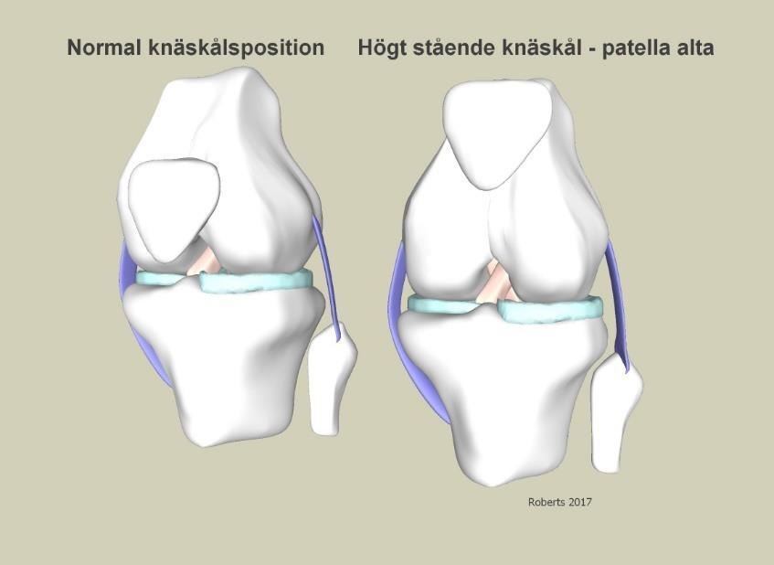 Hur ställer man diagnosen urledhoppning av knäskålen? Vid felställd knäskål är diagnosen lätt att ställa, både för dig som patient och sjukvårdspersonal.