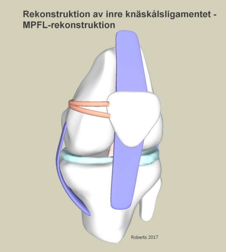B. Lagning av inre knäskålsledbandet (Mediala Patello Femorala Ligamentet), MPFL-rekonstruktion.