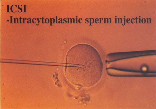 Indikation för ICSI: Lågt spermieantal Låg befruktning efter rutin IVF Dålig
