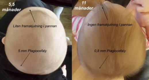 Dessutom, när ett platt huvud är färdigbehandlat bör avlastning fortsätta ske till dess att fontanellen är sluten.