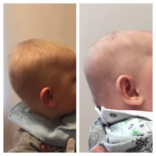 Bild till vänster är bebis tre månader och har inte använt Mimos kudde.