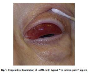 MALT- lymfom i ögat Engagemang i konjunktiva (bindehinnan) Tumor bredvid/bakom ögat Vanligt med bakomliggande autoimmun sjukdom