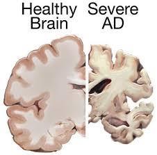 De vanligaste demenssjukdomarna Degenerativa sjukdomar (dvs nedbrytande ): Alzheimers Frontallobsdemens Lewy body demens Parkinsons sjukdom med demens Vaskulära