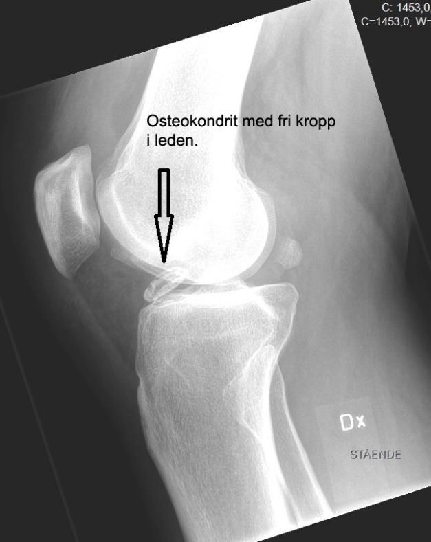 Vilka symptom ger osteokondrit? Hur ställer man diagnosen osteokondrit?