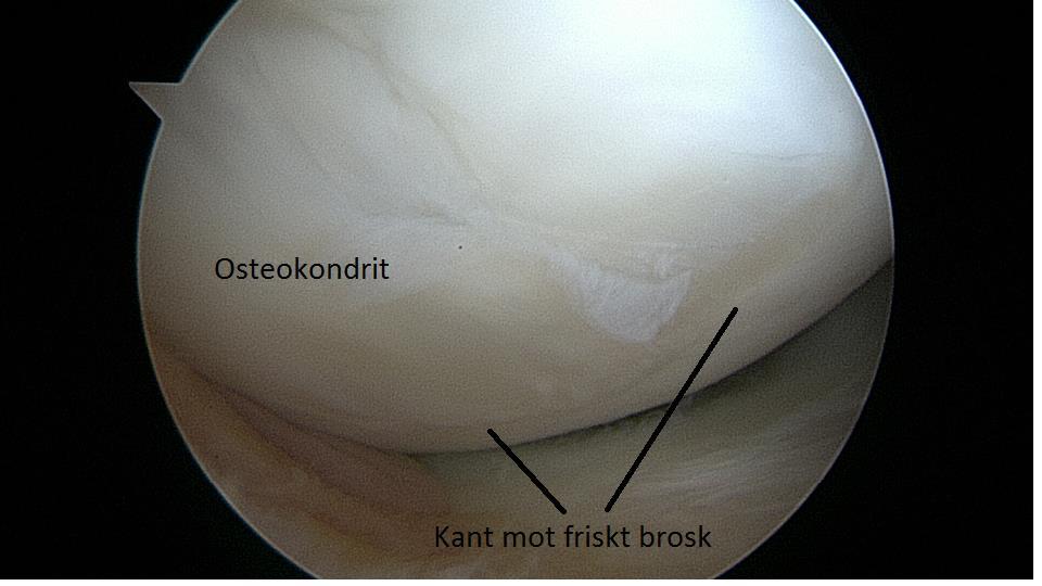 kvarvarande defekt, där ben-broskbiten suttit, ser ut och vilka symptom patienten har. Hur behandlas osteokondrit? Hos växande individer är prognosen god.