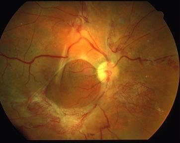 diabetesretinopati kan leda till näthinneförändringar,