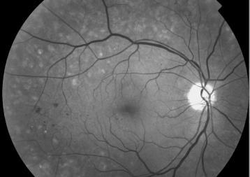 Behandlingskrävande DRP Proliferativ DRP Laserbehandling av ögonbotten utanför kärlbågarna, sk scatter.