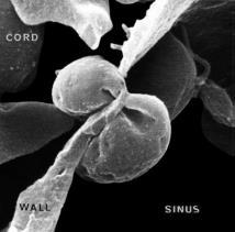 Defects in Erythrocyte Membrane Skeletal