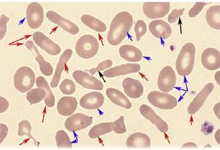 Splenomegali, transfusionskrävande anemi Sänkt uttryck av