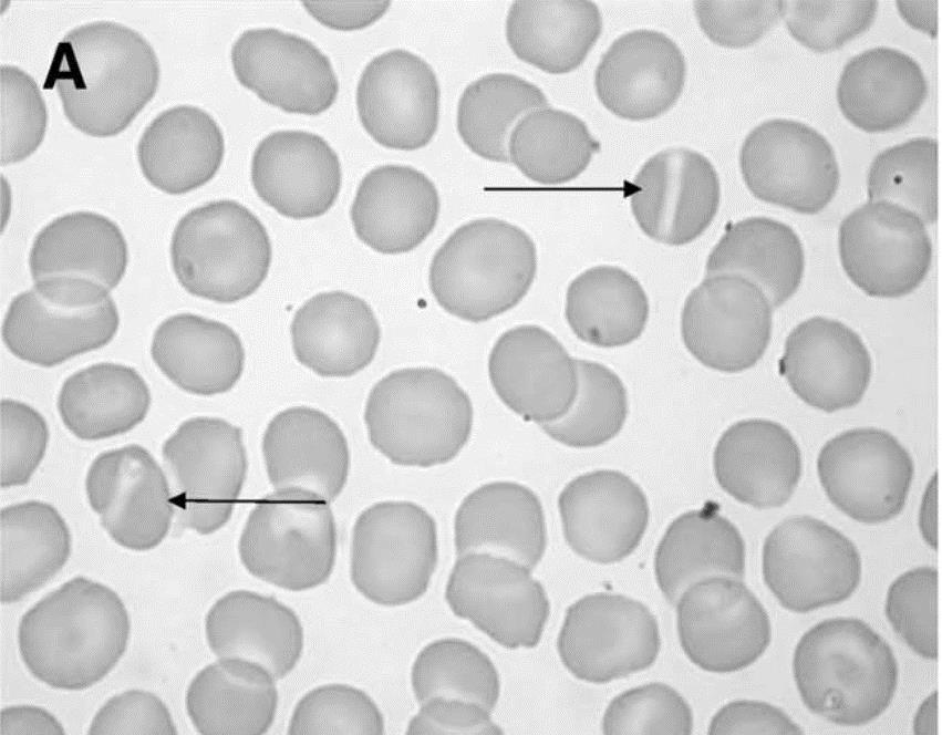 Dehydrerad Stomatocytos (Xerocytos) DHS Permeabilitetsrubbning i erytrocytens cellmembran Ery jontransport och hydrering defekt Autosomalt Dominant Två mutationer kända: PIEZO1 KCNN4 - kodar för