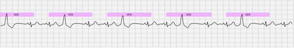 Kategori 11 Fler än 5 ventrikulära extraslag (VES) detekterade över 30 sekunder (endast 10 sekunder i ovanstående EKG). Kategori 12 Oregelbunden sekvens med detekterade P-vågor.