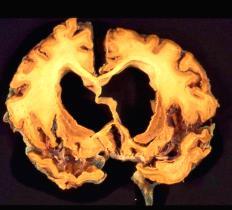 vid Alzheimer jämfört med Pannlobsdemens Skillnaden förklarar varför symtomen är helt