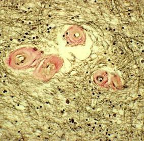 (Mikroangiogram av frontallob) med långa sårbara penetranter i vit substans Arterioloskleros i kärlväggen med