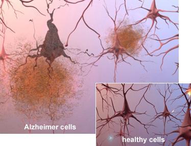 Andra sjd: infarkt, parkinsonism, infektion, trauma Livsstil: alkohol, tobak, medicinering, kost 3 stadier av Alzheimer, nyss redovisade av L Gustafson Tidigt stadium Långsam utveckling Trötthet,