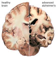 Normal --- Alzheimer Utbredning av förändringar vid Alzheimers sjukdom förklarar symtomen. I slutstadier mer generell skada A Alzheimer.