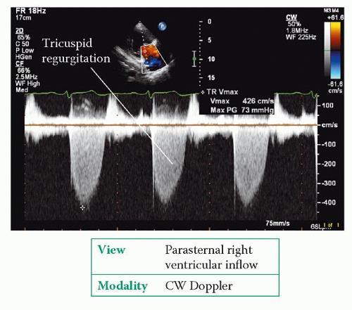 PH Målet är tidig diagnos och klassificering. 1. Historia av tilltagande dyspne. 2. Ekg 3. pbnp (Osannolikt om normalt) 4.