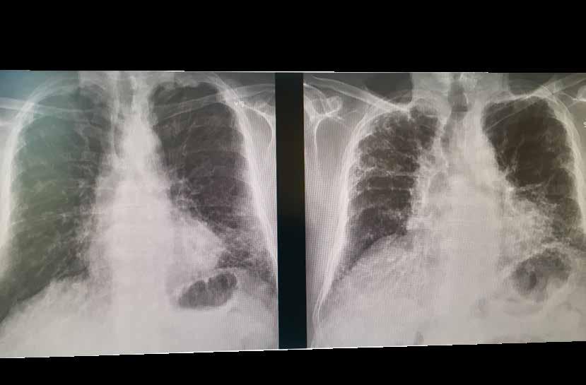 Till vänster lungorna på en 69-årig man med idiopatisk lungfibros. Till höger samma lungor sex år senare, när sjukdomen nått ett mer avancerat stadium med försämrad lungfunktion.