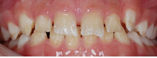 Att diagnostisera känslighet i tänderna och hypomineralisation utan färgförändring (figur I c), där emaljen är rå vid sondering och ytan känslig är svårare att se och missas ofta [3].