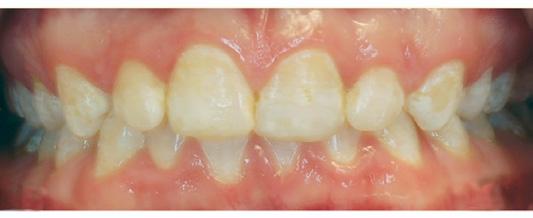 patienterna med AI (figur II a) och att sensitiviteten i tänderna ökade signifikant med antal omgjorda fyllningar [8].