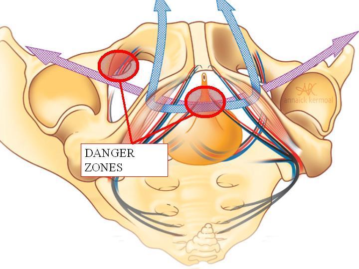 Suburethral sling plasty Alternate routes Through foramen