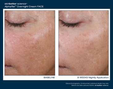 AlphaRet Overnight Cream FACE The NEW gold standard in in skin rejuvenation.