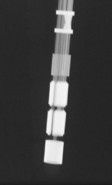 fluoroskopisk bild); de distala elektroderna är mörkare än den mest proximala osegmenterade elektroden.