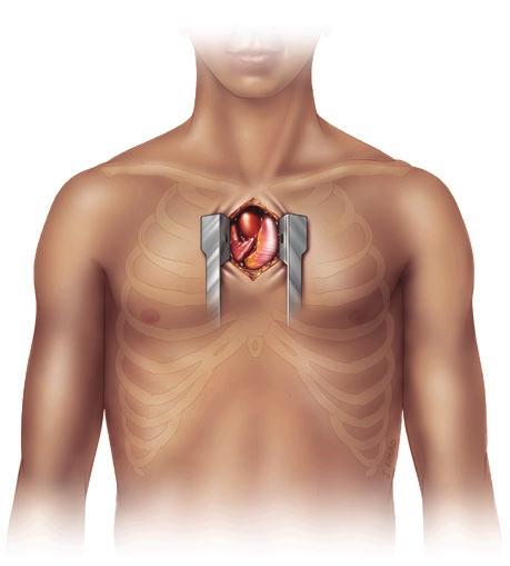 Vilka behandlingsalternativ finns det för aortastenos? Min kardiolog förklarade att det för svår aortastenos finns två behandlingsalternativ.
