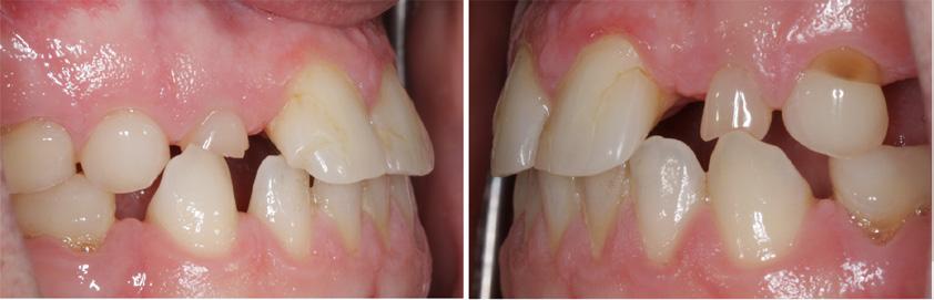 I detta fall fungerade efter hand de primära tänderna så dåligt att en mer omfattande behandling blev nödvändig.