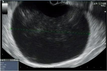 Endometriom =