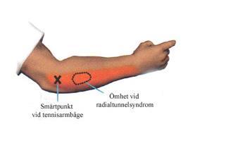 Differentialdiagnoser Proximala nervskador såsom inflammation eller