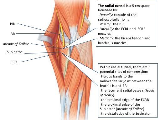 Definition radialtunnelsyndrom Inklämning av n.