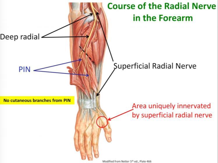 Posterior interosseous syndrome (PIS) och RTS PIS involverar primärt motorisk funktion (extensorerna) utan sensorisk påverkan.