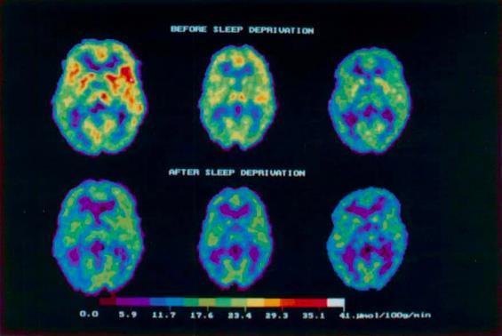 Trötthet påverkar kognition & emotion: implikationer för beslutsfattande & prestation Sämre uppmärksamhet & koncentration Försämrad exekutiv förmåga: Hålla koll/komma ihåg senaste utvecklingen