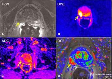 Magnetkamera (MRI) för att hitta eller utesluta en farlig cancer?