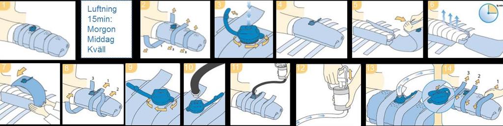 Bilaga 7 Stelt Vakuumförband - skötsel postoperativt Stelt vakuumförband Skötsel Vakuumförbandet används i ca 7 14 dagar postoperativt. Patientbundna pumpar.