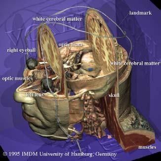 Virtuell verklighet - utbildning VoxelMan - 3D Anatomy Data The Visible Human Project