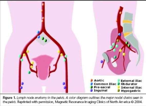 PSMA-Primär: Studiedesign Öppen och prospektiv. Inklusion kriterier: PCa patienter planerade för prostatectomi med lymfkörtelutrymning, vilket bestäms på MDK.